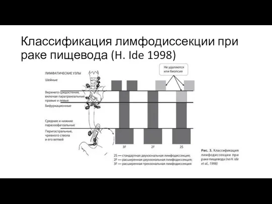 Классификация лимфодиссекции при раке пищевода (H. Ide 1998)