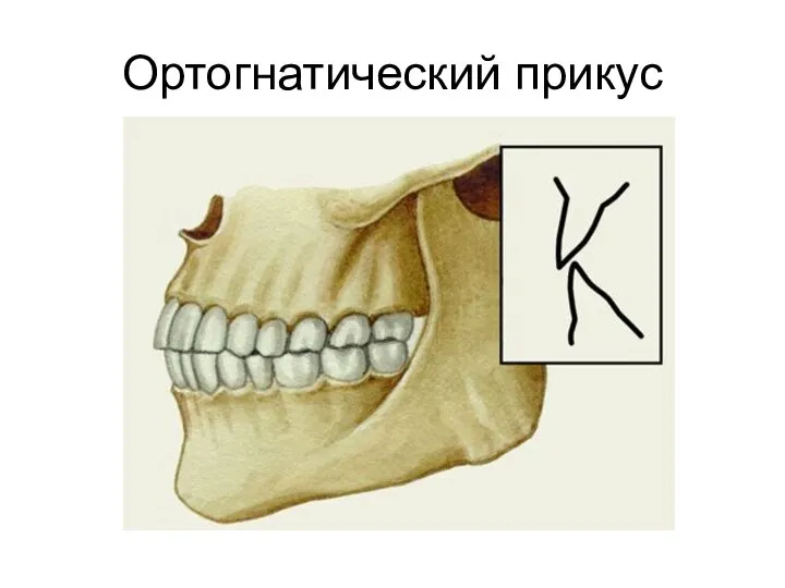 Ортогнатический прикус