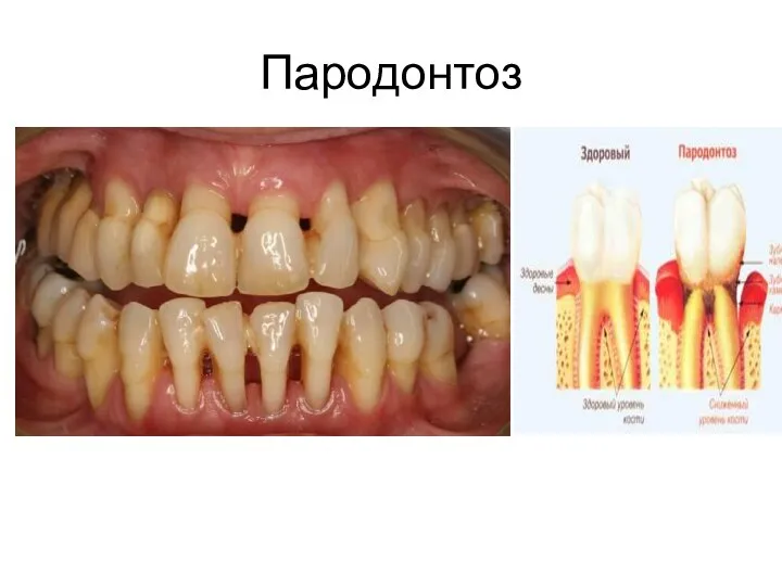 Пародонтоз