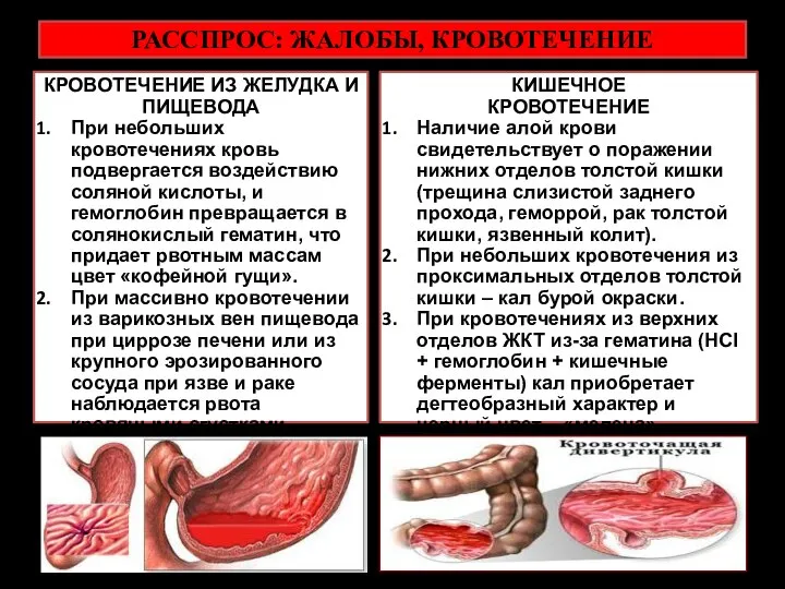 РАССПРОС: ЖАЛОБЫ, КРОВОТЕЧЕНИЕ КРОВОТЕЧЕНИЕ ИЗ ЖЕЛУДКА И ПИЩЕВОДА При небольших кровотечениях кровь