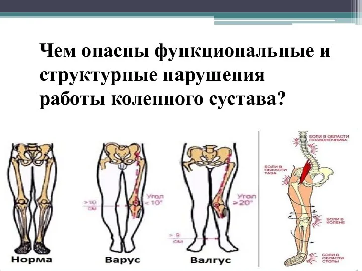 Чем опасны функциональные и структурные нарушения работы коленного сустава?