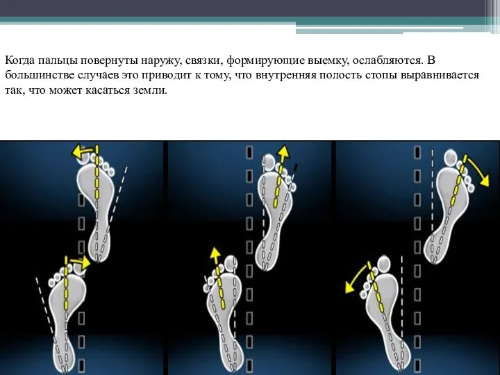 Когда пальцы повернуты наружу, связки, формирующие выемку, ослабляются. В большинстве случаев это