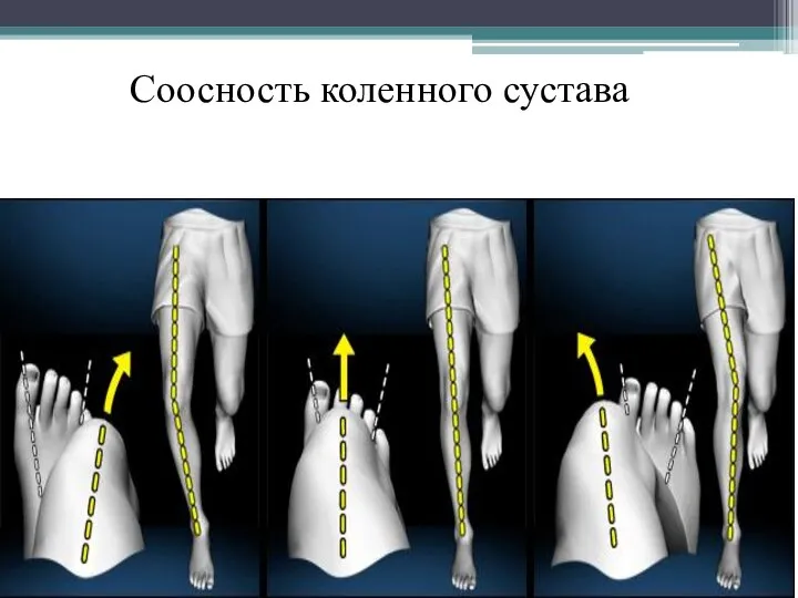 Соосность коленного сустава