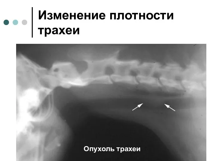 Изменение плотности трахеи Опухоль трахеи