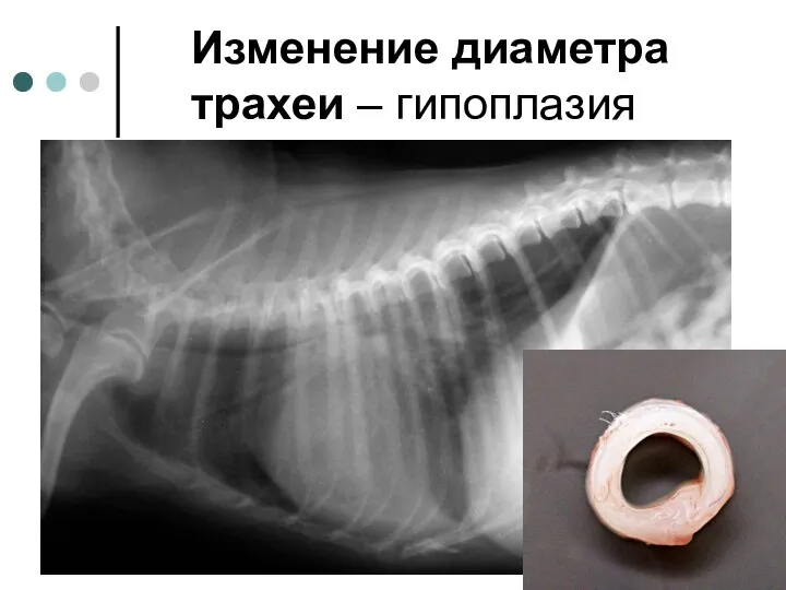 Изменение диаметра трахеи – гипоплазия Коллапс трахеи