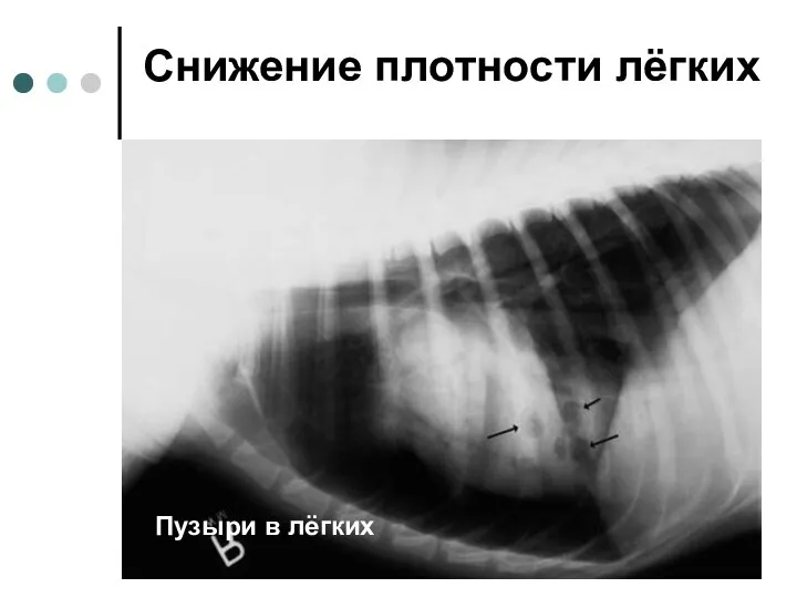 Снижение плотности лёгких Пузыри в лёгких