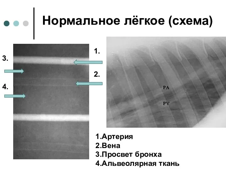 1. 2. 3. 4. 1.Артерия 2.Вена 3.Просвет бронха 4.Альвеолярная ткань Нормальное лёгкое (схема)