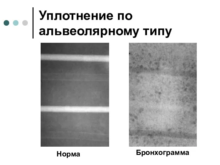 Уплотнение по альвеолярному типу Норма Бронхограмма