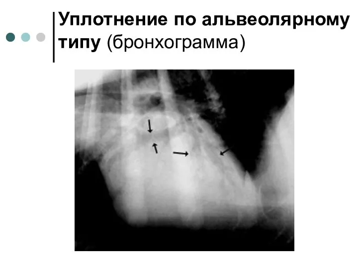 Уплотнение по альвеолярному типу (бронхограмма)