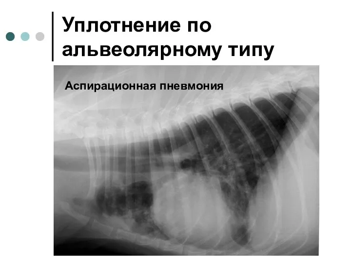 Уплотнение по альвеолярному типу Аспирационная пневмония