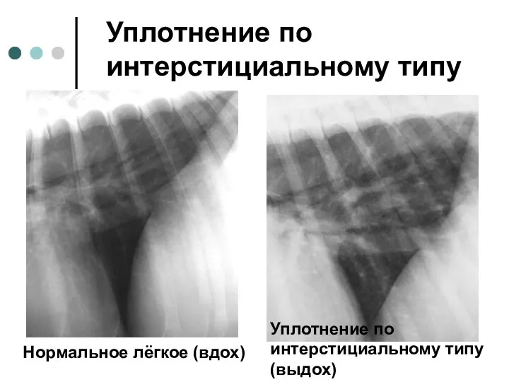 Уплотнение по интерстициальному типу Нормальное лёгкое (вдох) Уплотнение по интерстициальному типу (выдох)