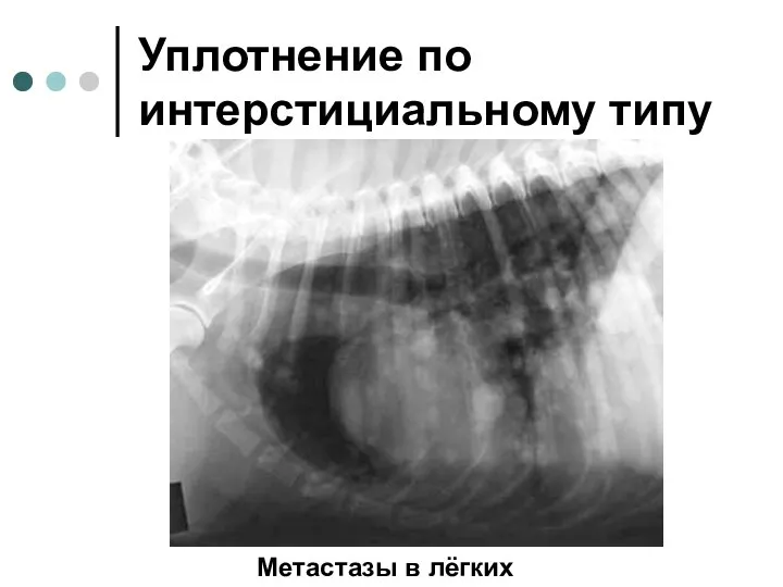 Уплотнение по интерстициальному типу Метастазы в лёгких