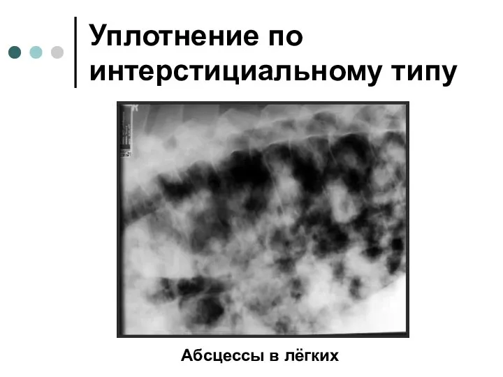 Уплотнение по интерстициальному типу Абсцессы в лёгких