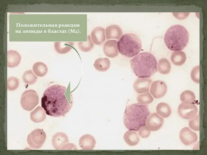 Положительная реакция на липиды в бластах (М2).