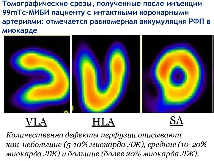 Томографические срезы, полученные после инъекции 99mТс-МИБИ пациенту с интактными коронарными артериями: отмечается