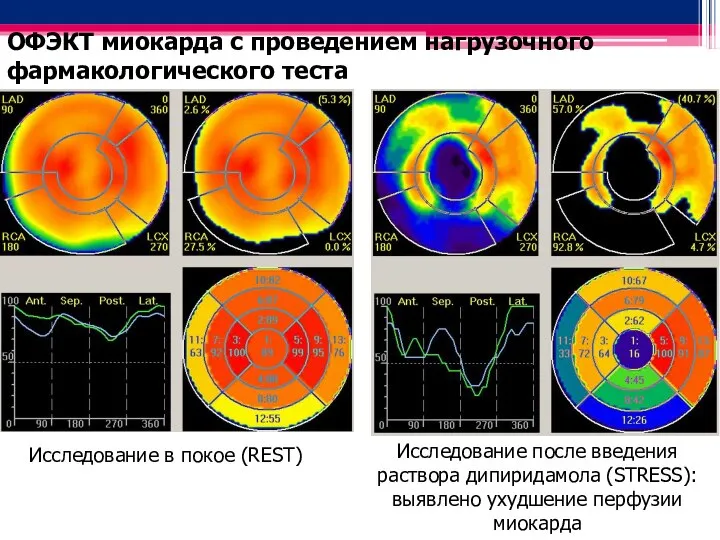 Исследование в покое (REST) Исследование после введения раствора дипиридамола (STRESS): выявлено ухудшение