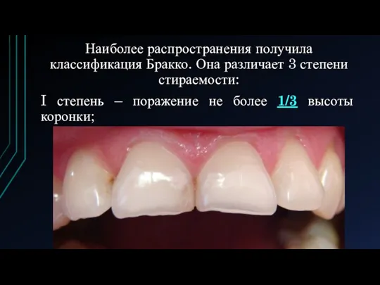 Наиболее распространения получила классификация Бракко. Она различает 3 степени стираемости: I степень