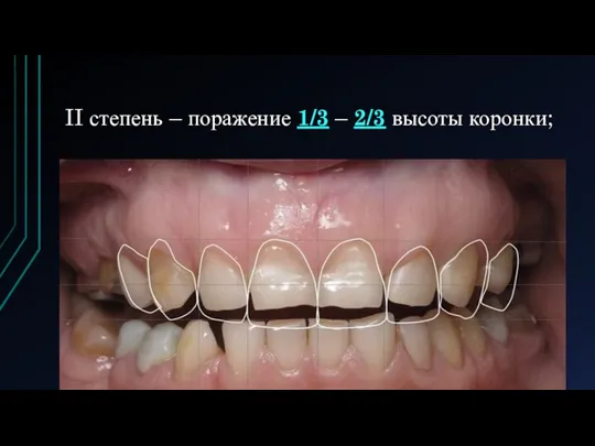 II степень – поражение 1/3 – 2/3 высоты коронки;