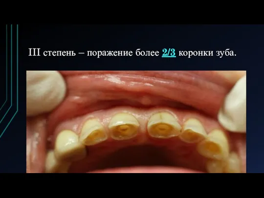 III степень – поражение более 2/3 коронки зуба.