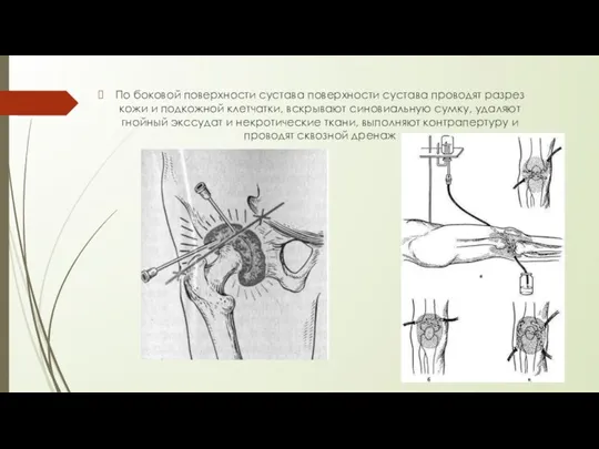 По боковой поверхности сустава поверхности сустава проводят разрез кожи и подкожной клетчатки,