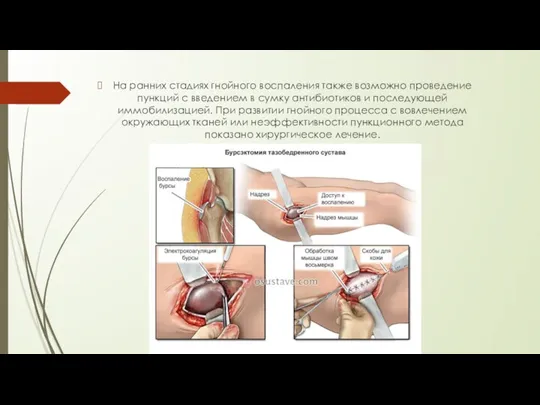 На ранних стадиях гнойного воспаления также возможно проведение пункций с введением в