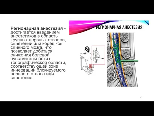 Регионарная анестезия - достигается введением анестетиков в область крупных нервных стволов, сплетений