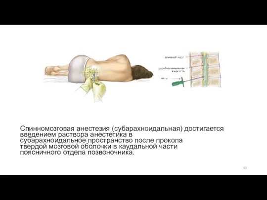 Спинномозговая анестезия (субарахноидальная) достигается введением раствора анестетика в субарахноидальное пространство после прокола