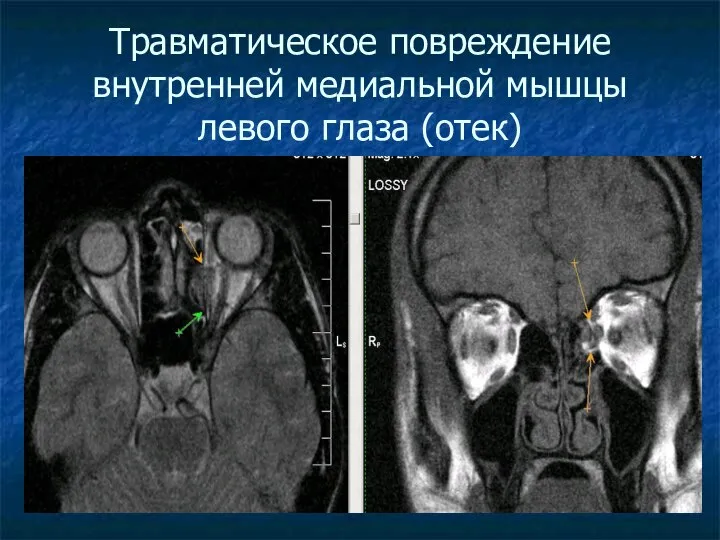 Травматическое повреждение внутренней медиальной мышцы левого глаза (отек)