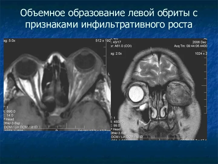 Объемное образование левой обриты с признаками инфильтративного роста