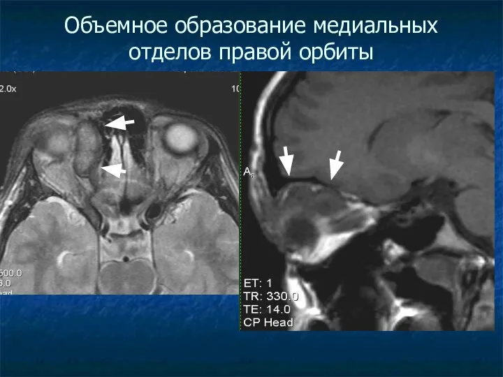 Объемное образование медиальных отделов правой орбиты