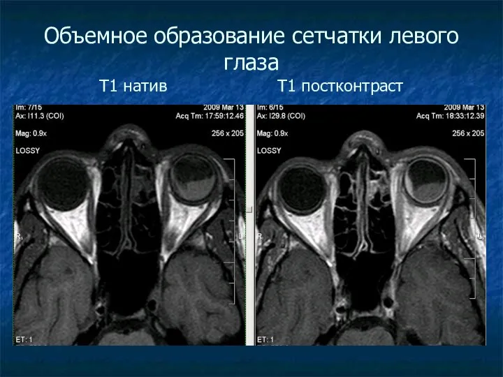 Объемное образование сетчатки левого глаза Т1 натив Т1 постконтраст