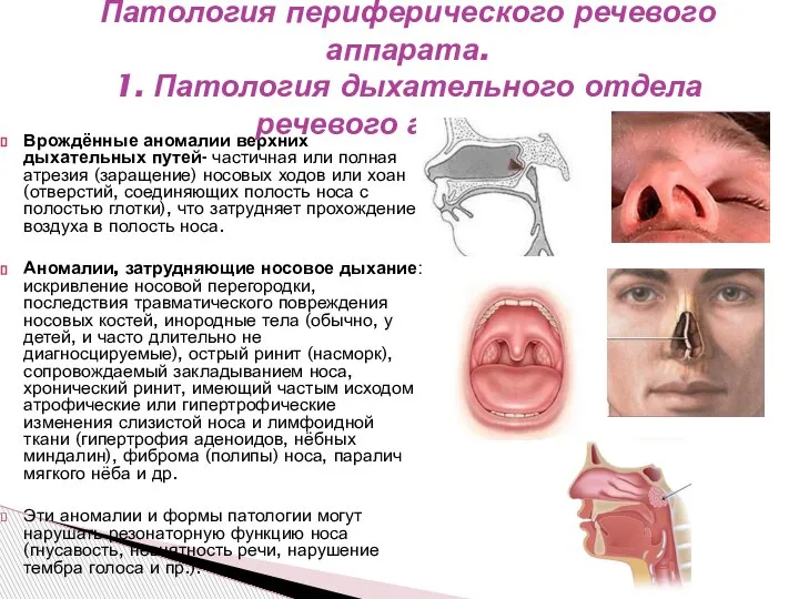 Врождённые аномалии верхних дыхательных путей- частичная или полная атрезия (заращение) носовых ходов