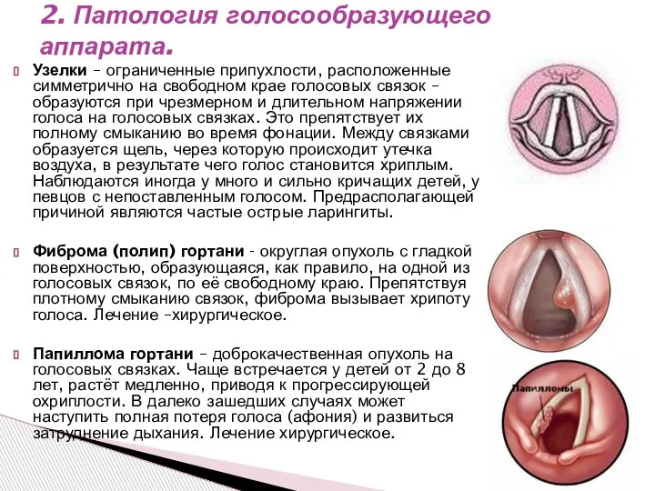 Узелки – ограниченные припухлости, расположенные симметрично на свободном крае голосовых связок –