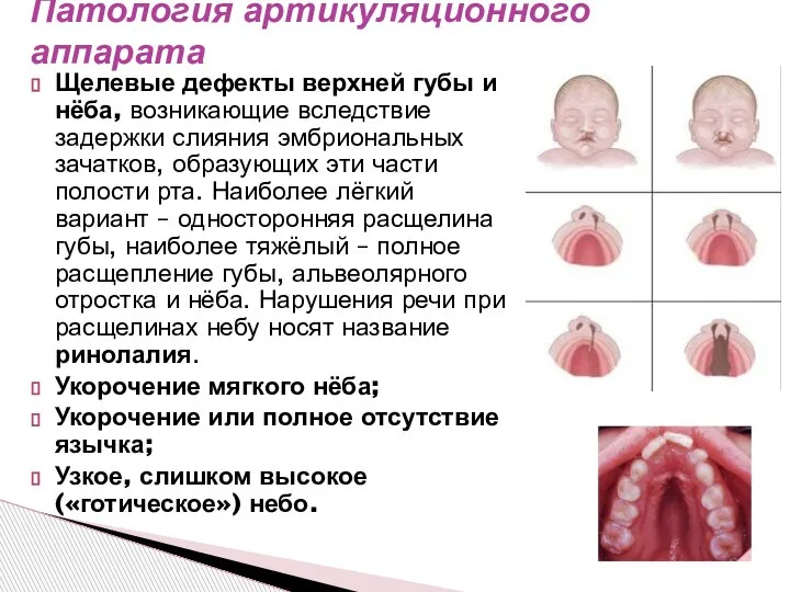 Щелевые дефекты верхней губы и нёба, возникающие вследствие задержки слияния эмбриональных зачатков,