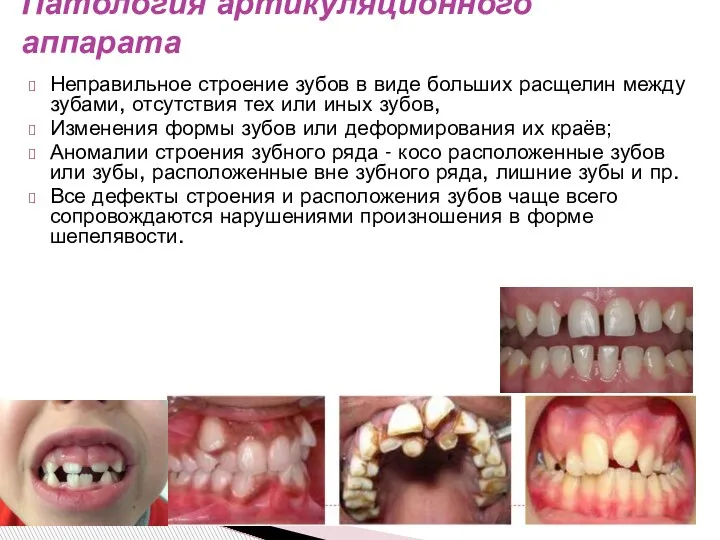 Неправильное строение зубов в виде больших расщелин между зубами, отсутствия тех или