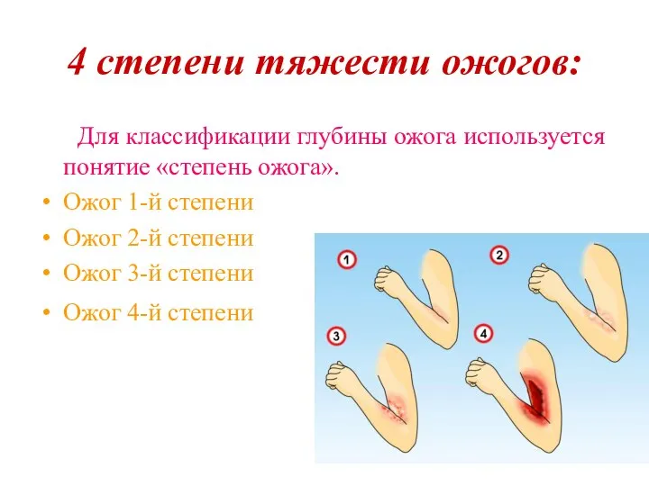 4 степени тяжести ожогов: Для классификации глубины ожога используется понятие «степень ожога».