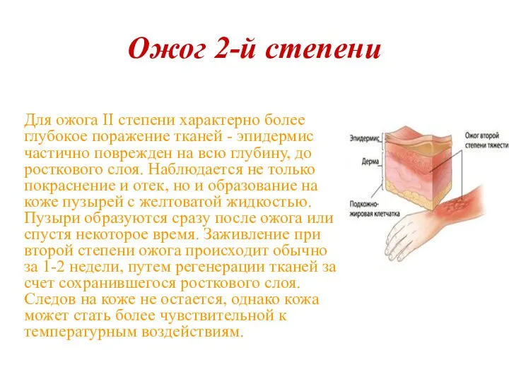 Ожог 2-й степени Для ожога II степени характерно более глубокое поражение тканей