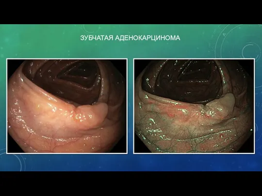 ЗУБЧАТАЯ АДЕНОКАРЦИНОМА