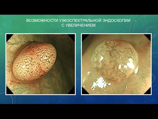 ВОЗМОЖНОСТИ УЗКОСПЕКТРАЛЬНОЙ ЭНДОСКОПИИ С УВЕЛИЧЕНИЕМ
