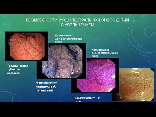 ВОЗМОЖНОСТИ УЗКОСПЕКТРАЛЬНОЙ ЭНДОСКОПИИ С УВЕЛИЧЕНИЕМ Хромоскопия 0,5% раствором indigo carmini IV тип
