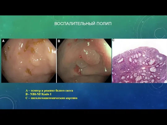 А – осмотр в режиме белого света В - NBI-NF/Kudo I С