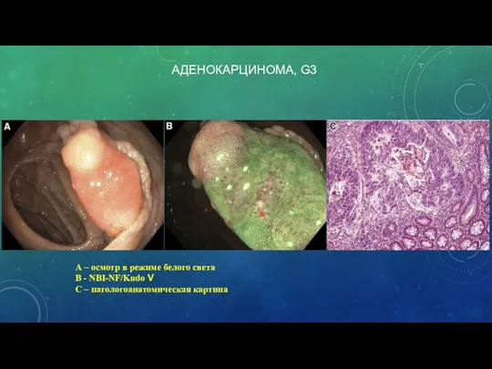 А – осмотр в режиме белого света В - NBI-NF/Kudo V С