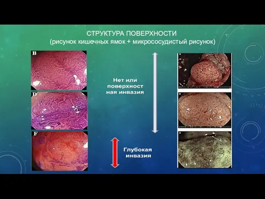 СТРУКТУРА ПОВЕРХНОСТИ (рисунок кишечных ямок + микрососудистый рисунок)