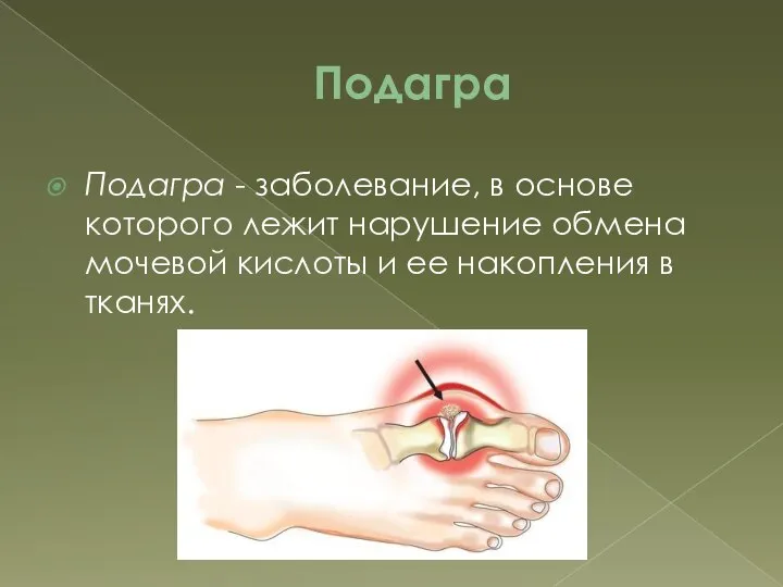 Подагра Подагра - заболевание, в основе которого лежит нарушение обмена мочевой кислоты