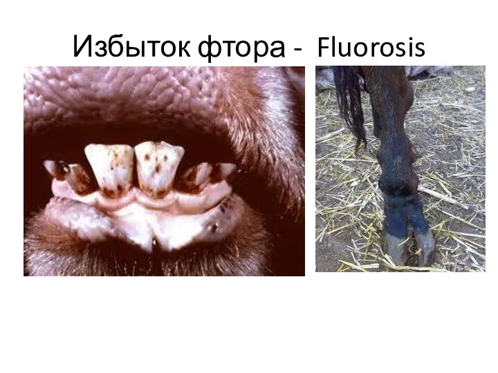 Избыток фтора - Fluorosis