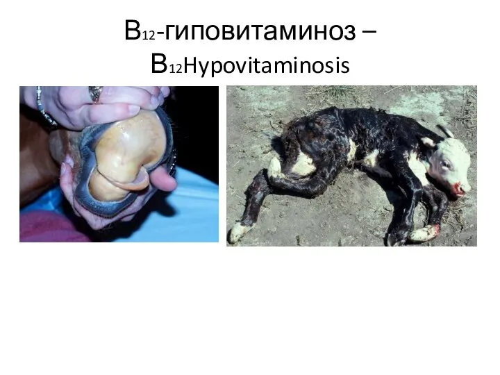 В12-гиповитаминоз – В12Hypovitaminosis