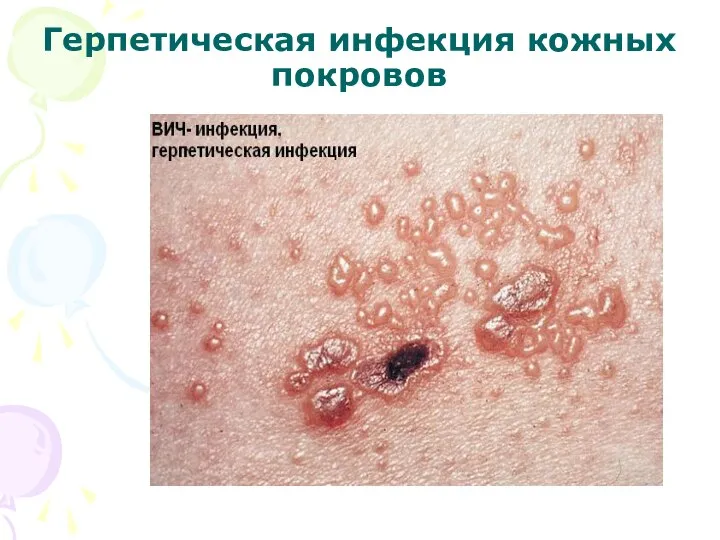 Герпетическая инфекция кожных покровов