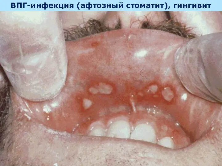 ВПГ-инфекция (афтозный стоматит), гингивит