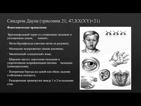 Синдром Дауна (трисомия 21; 47,XX(XY)+21) Фенотипические проявления: Брахицефальный череп со сглаженным затылком