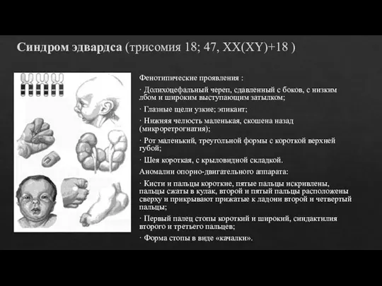 Синдром эдвардса (трисомия 18; 47, XX(XY)+18 ) Фенотипические проявления : · Долихоцефальный